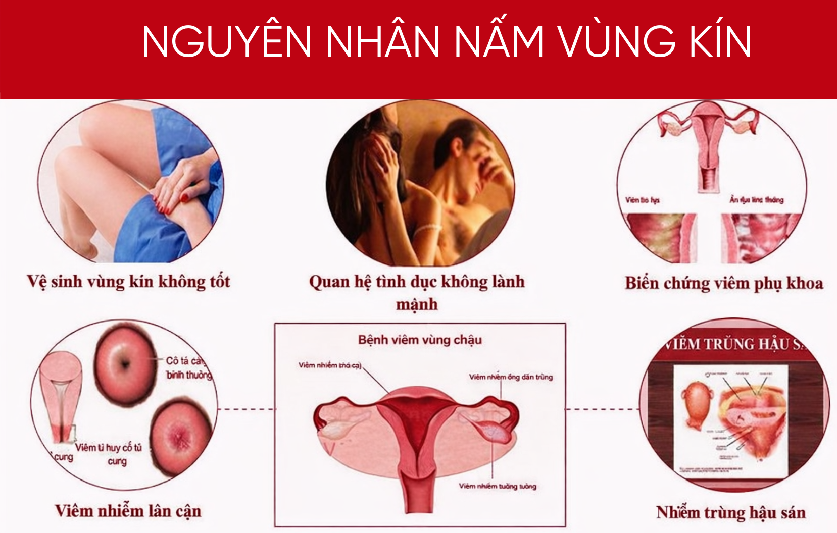 Mô tả hình ảnh: Hình ảnh về các yếu tố gây nấm vùng kín, với các biểu tượng tượng trưng cho kháng sinh, quần lót không thoáng khí.